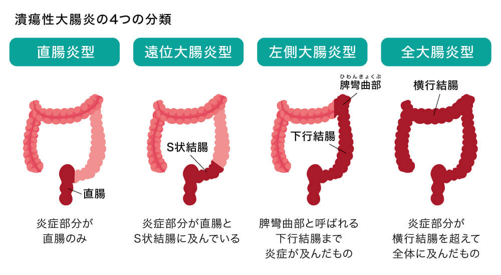 潰瘍性大腸炎