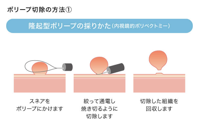 隆起型ポリープの採りかた（内視鏡的ポリペクトミー）