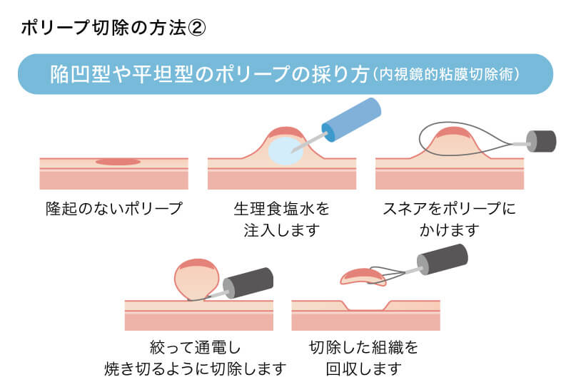 陥凹型や平坦型のポリープの採り方（内視鏡的粘膜切除術）