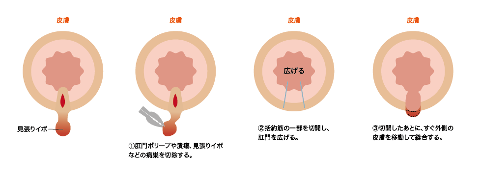 皮膚弁移動術（SSG）