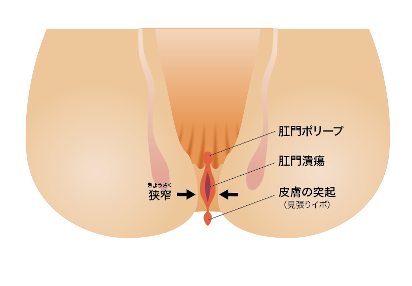 慢性裂肛