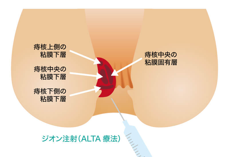 痔核注射療法(ALTA)