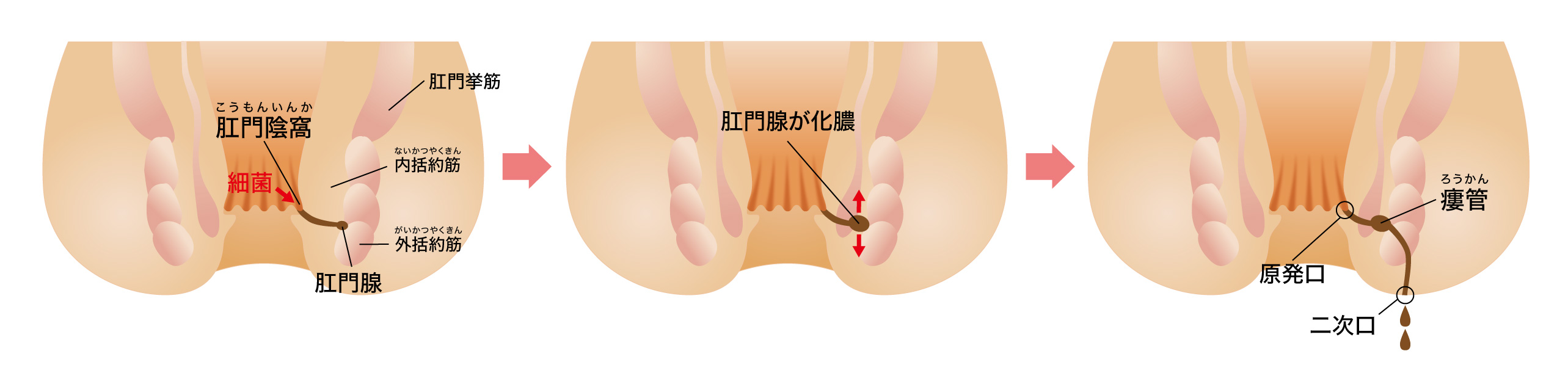 あな痔とは