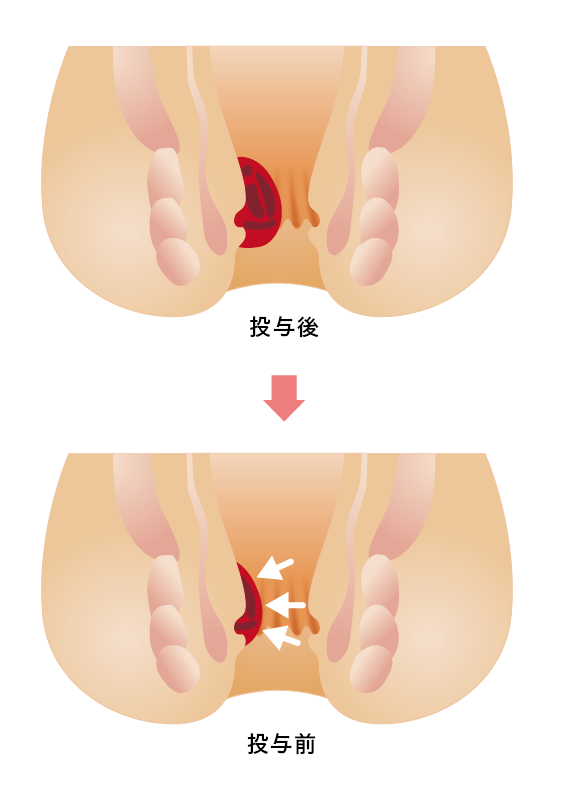 いぼ 痔 治療