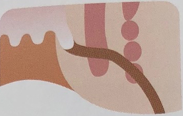 低位筋間痔瘻