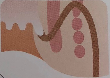 骨盤直腸窩痔瘻