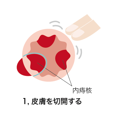 結紮切除術1