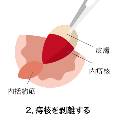 結紮切除術2