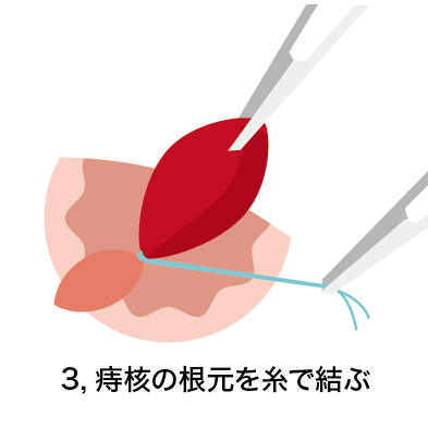 結紮切除術3