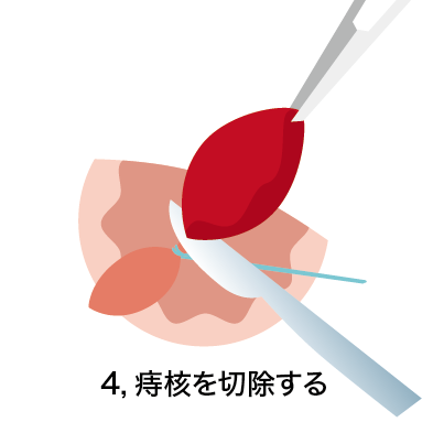 結紮切除術4