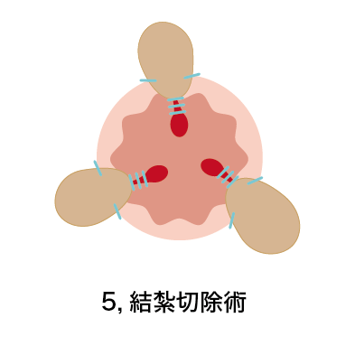 結紮切除術5