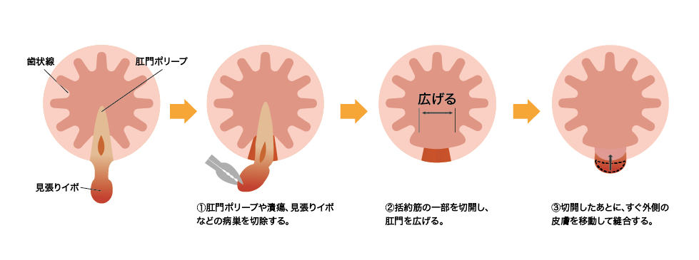 皮膚弁移動術