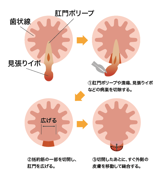 皮膚弁移動術