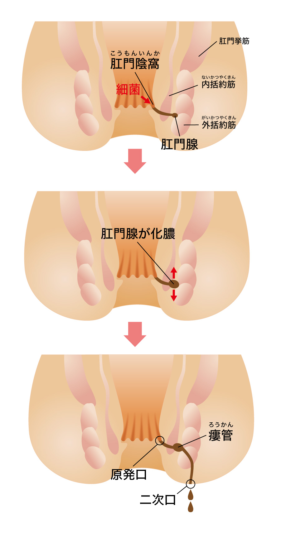 あな痔 痔瘻 について 荒川外科肛門科医院